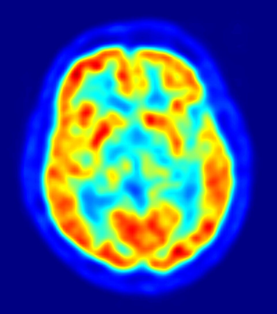 Addiction is a brain disease