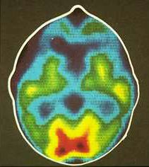 Low dopamine D2 receptors in addiction